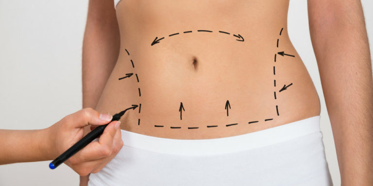 La mamoplastia, lipoaspiración y abdominoplastia encabezan el ranking de las cirugías más solicitadas imagen-24