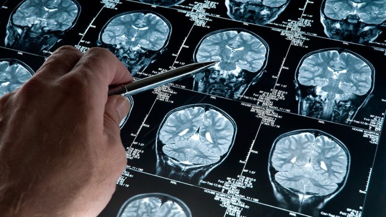 Científicos advirtieron que un "promisorio" fármaco contra el Alzheimer reduce el tamaño del cerebro imagen-9