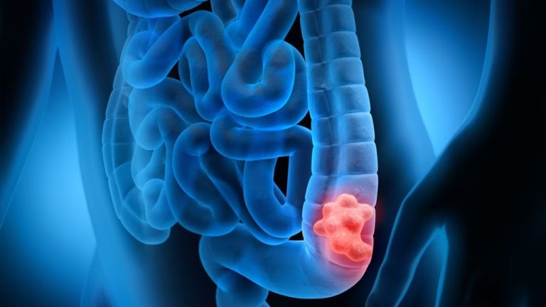 Advierten acerca de los signos y síntomas de alerta sobre el Cáncer de Colon imagen-19