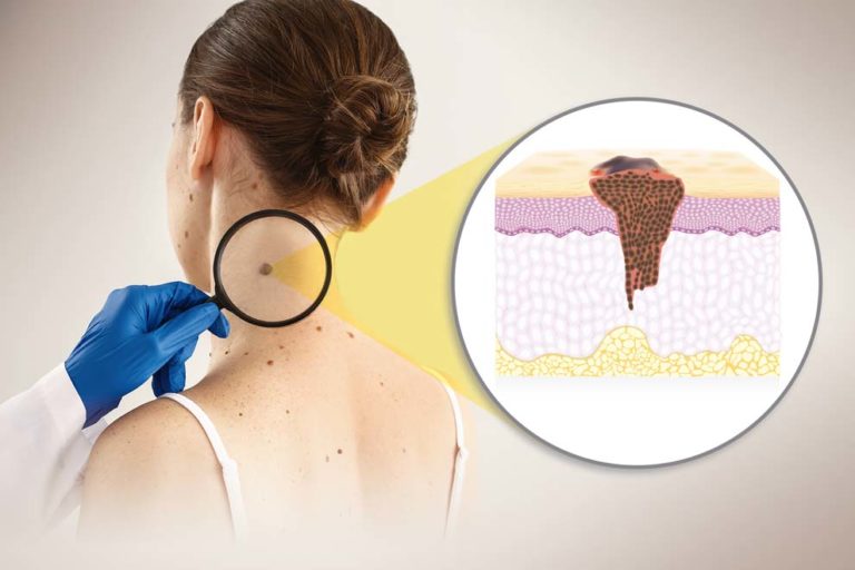 Científicos argentinos participarán del desarrollo de una vacuna aprobada contra el melanoma imagen-33