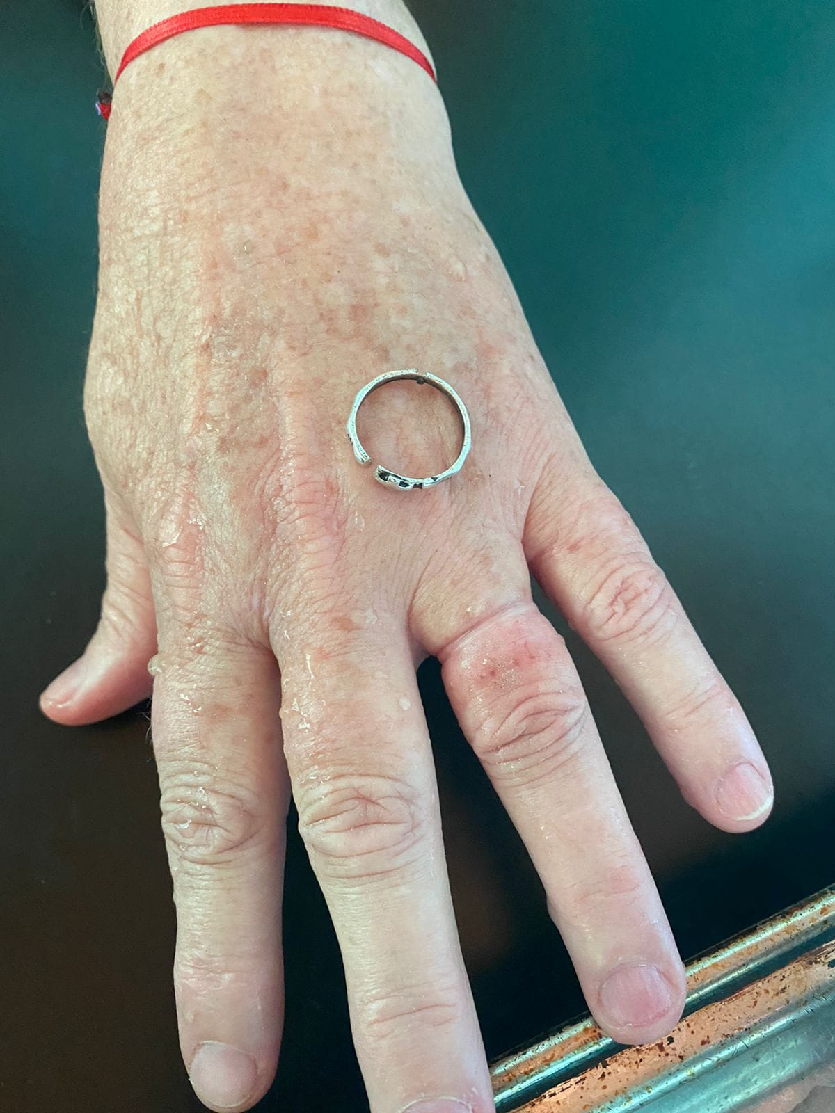 Bomberos asistieron a una mujer y le sacaron un anillo que dificultaba la circulación en su mano imagen-4
