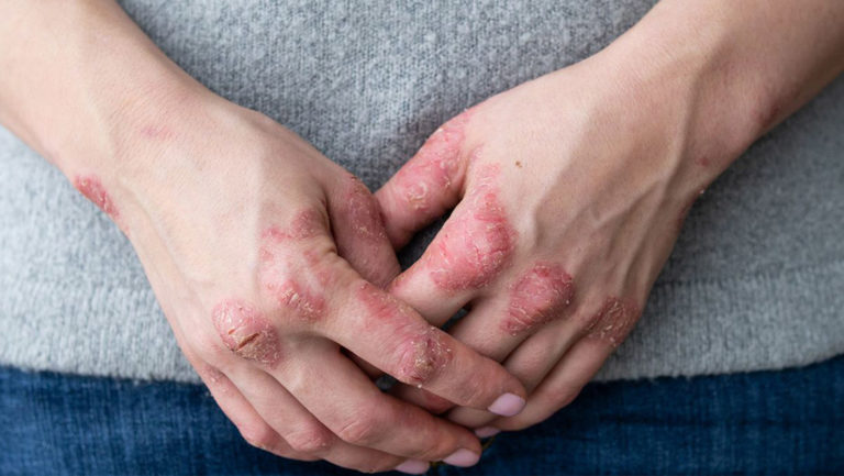 Realizarán campaña de concientización de la Psoriasis en el Cuarto Tramo de la Costanera  imagen-35