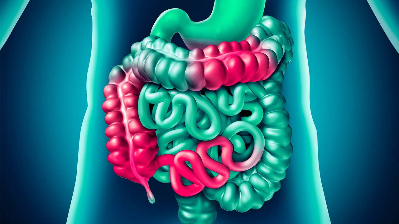 ¿Qué es la enfermedad de Crohn y la colitis ulcerosa? imagen-1
