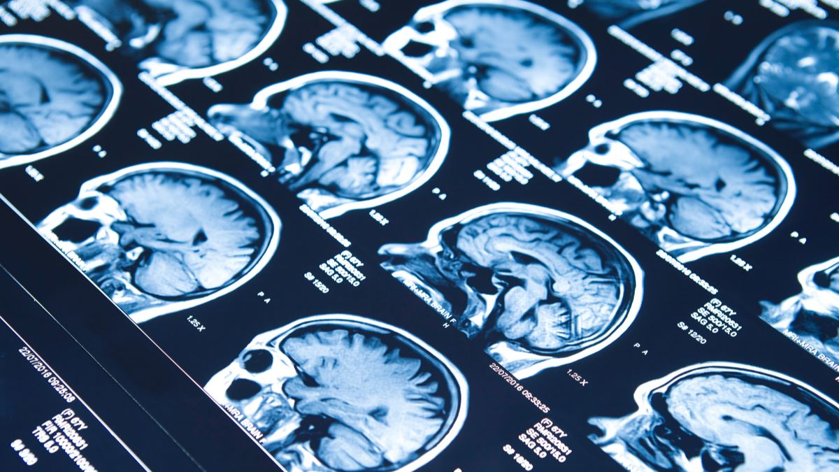Epilepsia: Neurólogos explican sobre qué trata esta patología que afecta al 1% de la población imagen-2