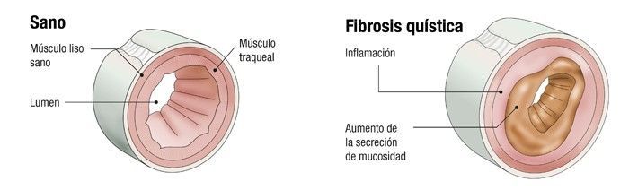 Día Mundial de la Fibrosis Quística: señalan la detección temprana es crucial para mejorar el pronóstico de la patología imagen-2