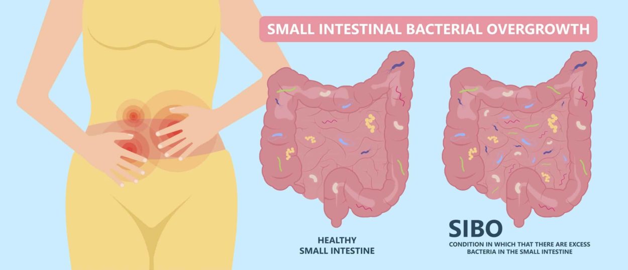 Gastroenterólogo explica qué es el Sibo, patología que afecta al intestino delgado y provoca hinchazón e incomodidad  imagen-2