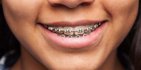 Odontóloga reveló cuándo es el mejor momento para usar ortodoncia imagen-10