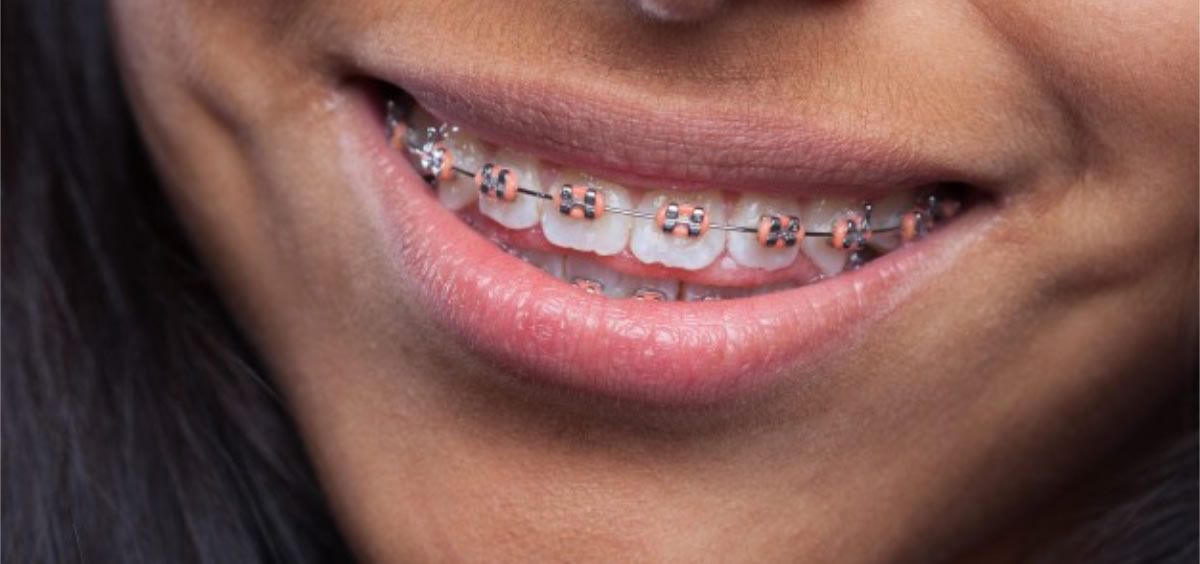 Odontóloga reveló cuándo es el mejor momento para usar ortodoncia imagen-2