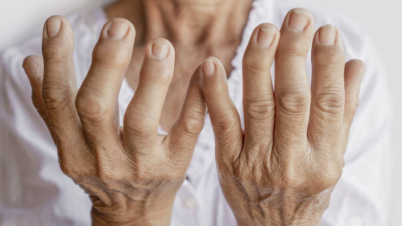 Destacan los factores de riesgo de la artritis reumatoidea y la importancia de la detección temprana imagen-1