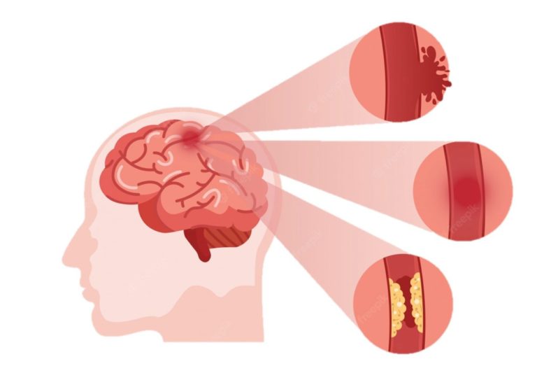 Hospital Escuela: Indican cuáles son los factores de riesgo modificables para prevenir accidentes cerebrovasculares imagen-23