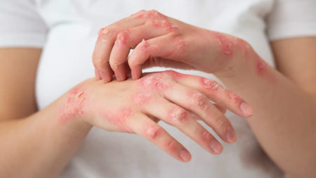 El Hospital Escuela cuenta con un consultorio para tratar Psoriasis, una enfermedad sistémica que afecta la piel imagen-4