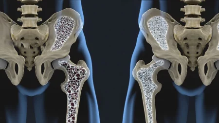 Osteoporosis: el 20% de los hombres corre riesgo de fracturas luego de los 50 años imagen-6