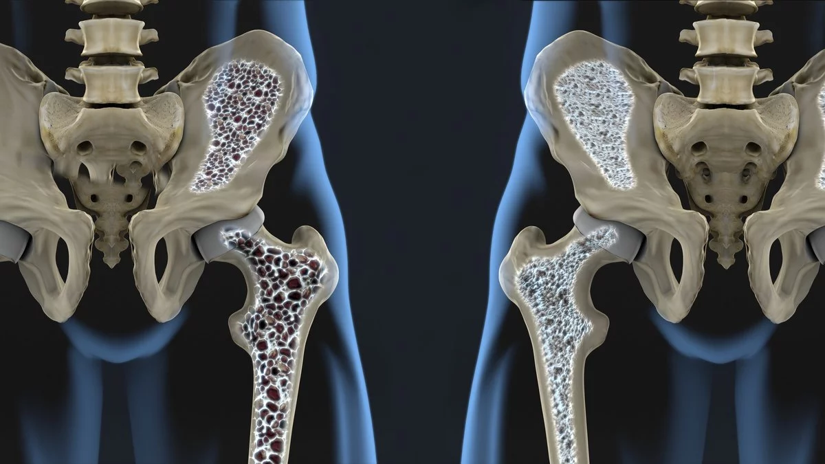 Osteoporosis: el 20% de los hombres corre riesgo de fracturas luego de los 50 años imagen-1
