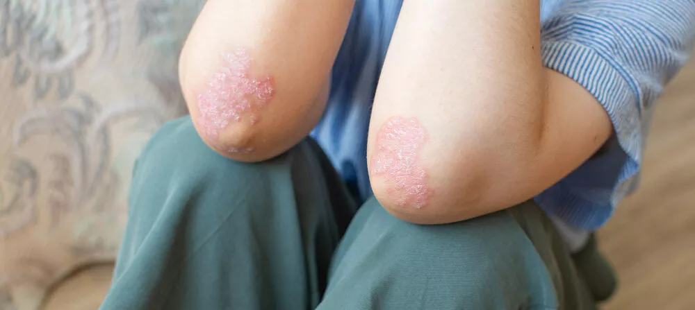 El Hospital Escuela cuenta con un consultorio para tratar Psoriasis, una enfermedad sistémica que afecta la piel imagen-4