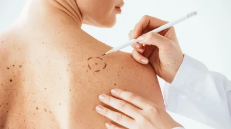 Profesionales del IMC aconsejan reforzar medidas de prevención y control médico para evitar el cáncer de piel imagen-8