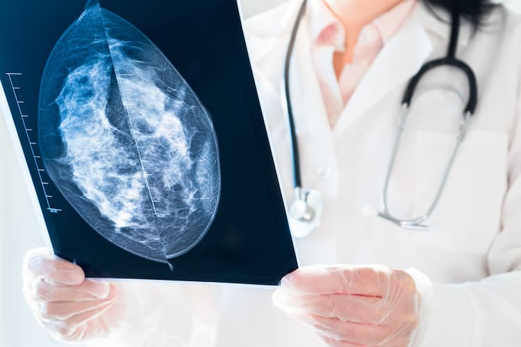 Científicos argentinos diseñaron una nueva droga para combatir un tipo de cáncer de mama imagen-1