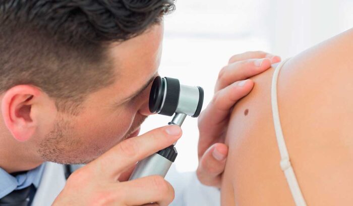 Dermatólogos recomiendan realizarse chequeos periódicos para prevenir el cáncer de piel imagen-4