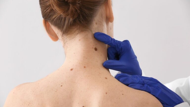 Día Mundial del Melanoma: por qué aumentan los casos, quiénes tienen más riesgo y cómo evitarlo imagen-19