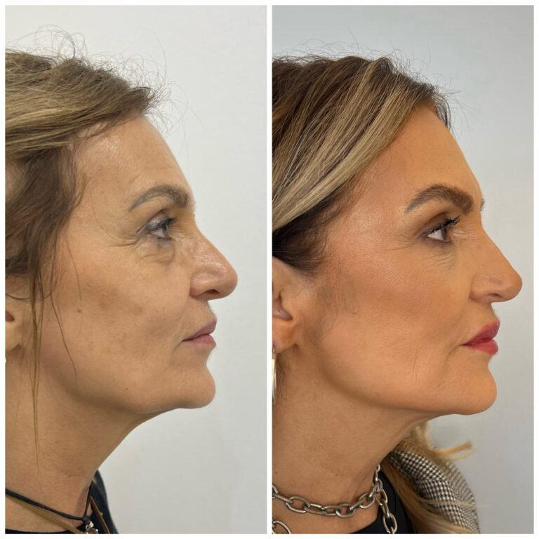 Revolución Estética: Los impactantes resultados de una intervención no quirúrgica en una paciente de 60 años imagen-30