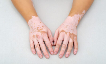Día Mundial del Vitiligo: cuatro claves sobre esta condición que afecta la pigmentación de la piel imagen-41