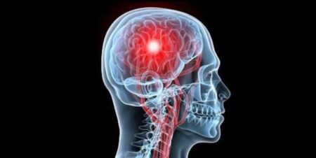 Importancia del programa para prevención, dignóstico y tratamiento de enfermedades cerebro vasculares imagen-10