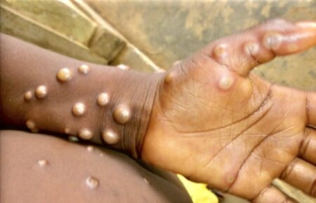 La OMS comparó la viruela del mono con el Covid-19: qué tienen en común y cuál es el alcance de la enfermedad imagen-9