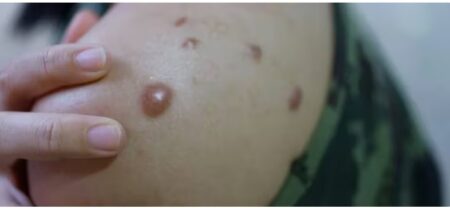 Confirmaron un caso de viruela del mono en Corrientes y ya son seis los detectados en el país imagen-8