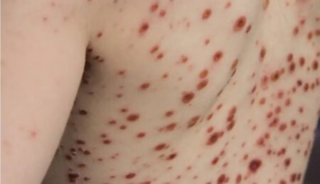 Alerta por viruela del mono en Argentina: cómo detectarla y en qué casos puede ocasionar la muerte imagen-10