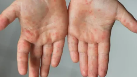 Viruela del mono: ¿pueden contagiarse las mascotas? imagen-3