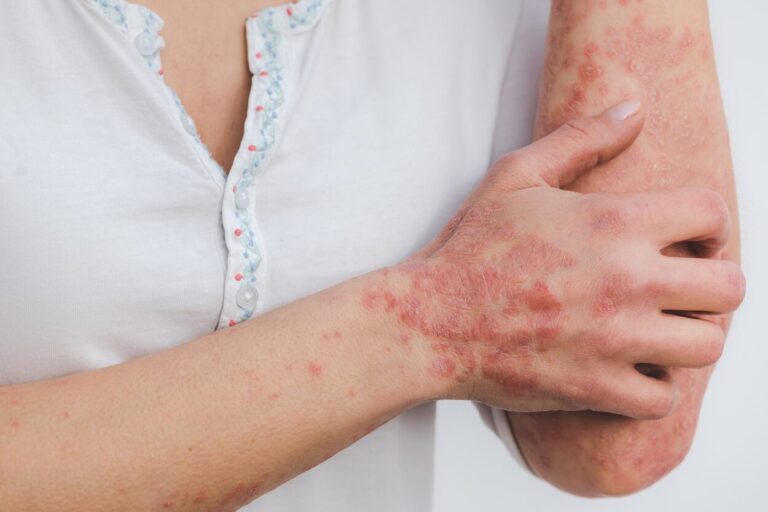 Día Mundial de la Psoriasis, una enfermedad que impacta en la vida cotidiana del 60% de los pacientes imagen-13