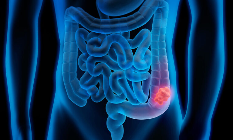 Cáncer de colon en América Latina: la detección temprana puede reducir más del 60% las muertes por la enfermedad imagen-5