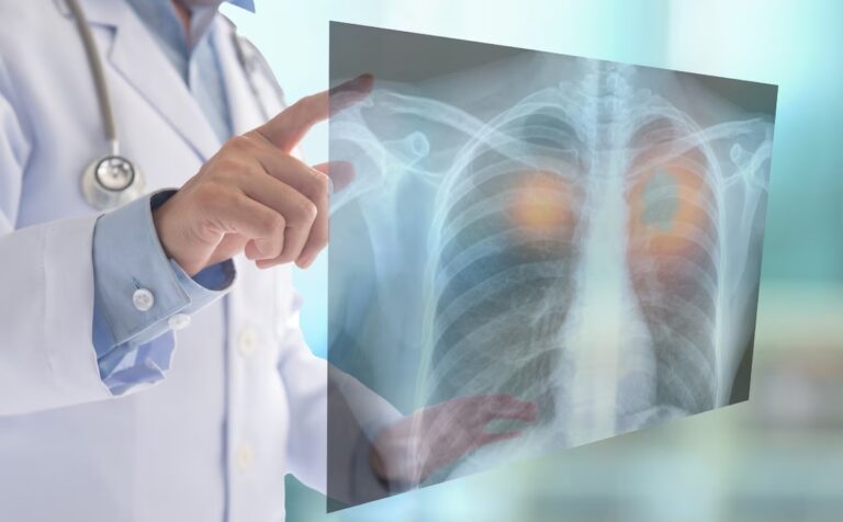 Cáncer de pulmón: cómo detectar a tiempo el tumor más mortal en Argentina imagen-26