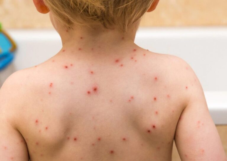 El regreso del sarampión en Argentina: Infectóloga explicó cómo la baja cobertura de vacunación está provocando brotes en zonas clave imagen-40