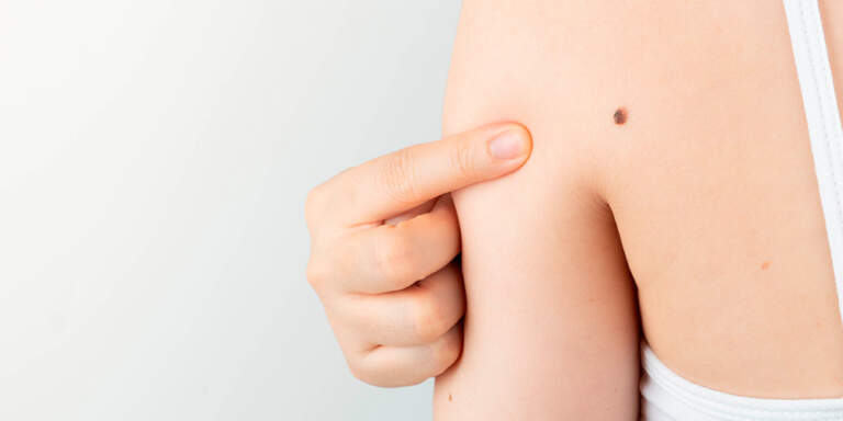 Día Mundial del Melanoma: cuáles son las señales de alerta que pueden detectarse en los lugares menos pensados imagen-12