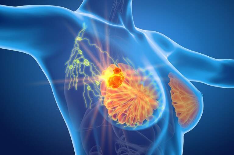 La IA puede detectar cánceres de mama difíciles de visualizar en las mamografías imagen-24