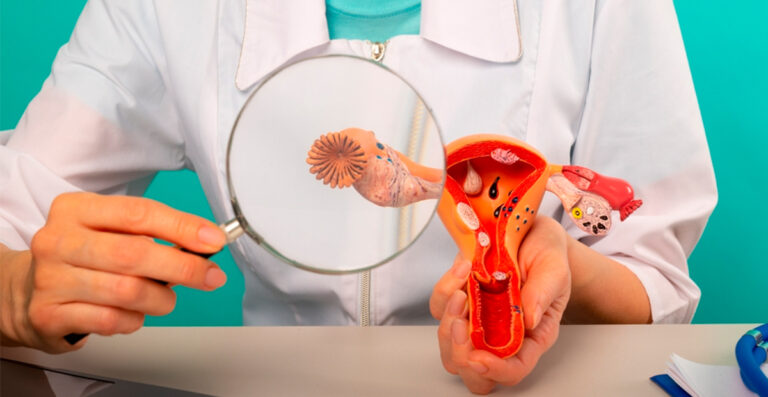 El 70% de los casos de cáncer de ovarios se detecta en estadios avanzados: cómo prevenir imagen-17