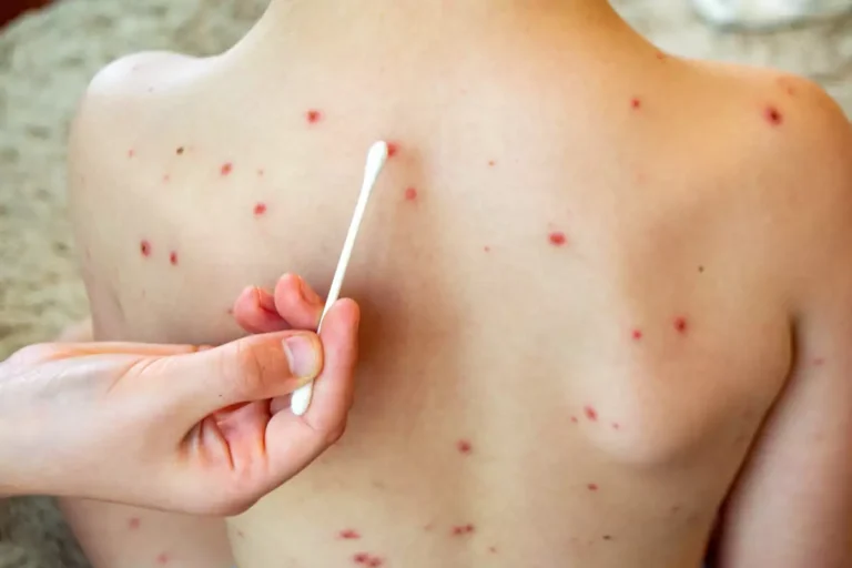 Brote de sarampión en Argentina: ya son 26 los casos confirmados este año imagen-10