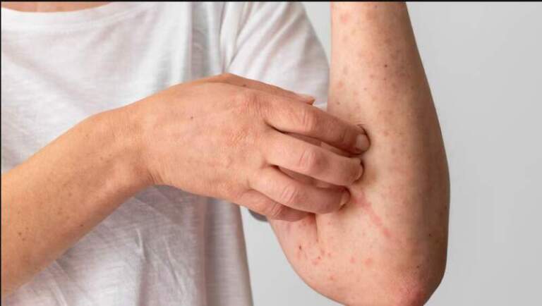 Día Mundial de la Alergia: los principales síntomas y cómo tratarlos, según los expertos Día Mundial de la Alergia: los principales síntomas y cómo tratarlos, según los expertos imagen-29