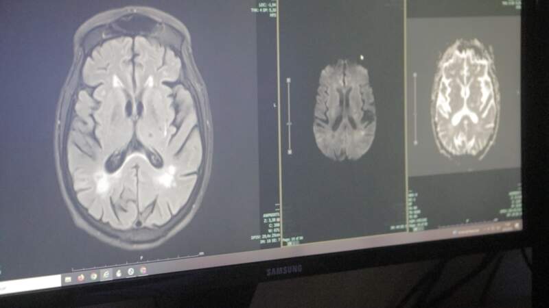 El Hospital Escuela realiza la innovadora cirugía de epilepsia receptiva, de desconexión y terapia de inmunomodulación 7 El Hospital Escuela realiza la innovadora cirugía de epilepsia receptiva, de desconexión y terapia de inmunomodulación imagen-6