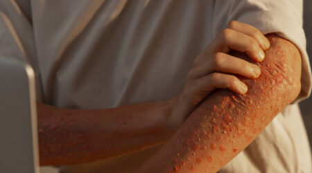 Advierten sobre el aumento de casos de sarna en Posadas y recomiendan controles dermatológicos anuales imagen-6