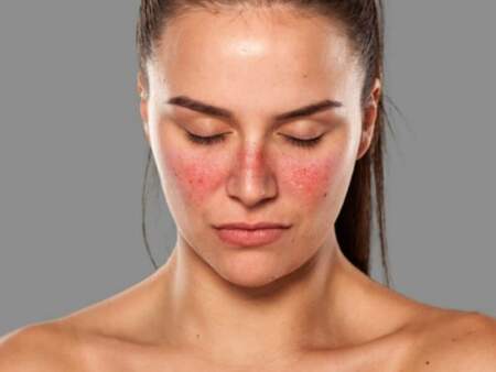 Lupus: una enfermedad autoinmune que el Madariaga aborda de manera integral imagen-2