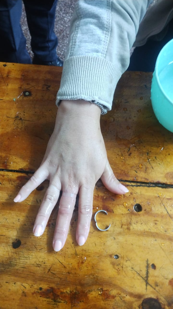 Triple intervención de bomberos: Una mujer asistida por un anillo atascado, un perro atrapado en un caño y un gato rescatado de un poste 7 Triple intervención de bomberos: Una mujer asistida por un anillo atascado, un perro atrapado en un caño y un gato rescatado de un poste imagen-6