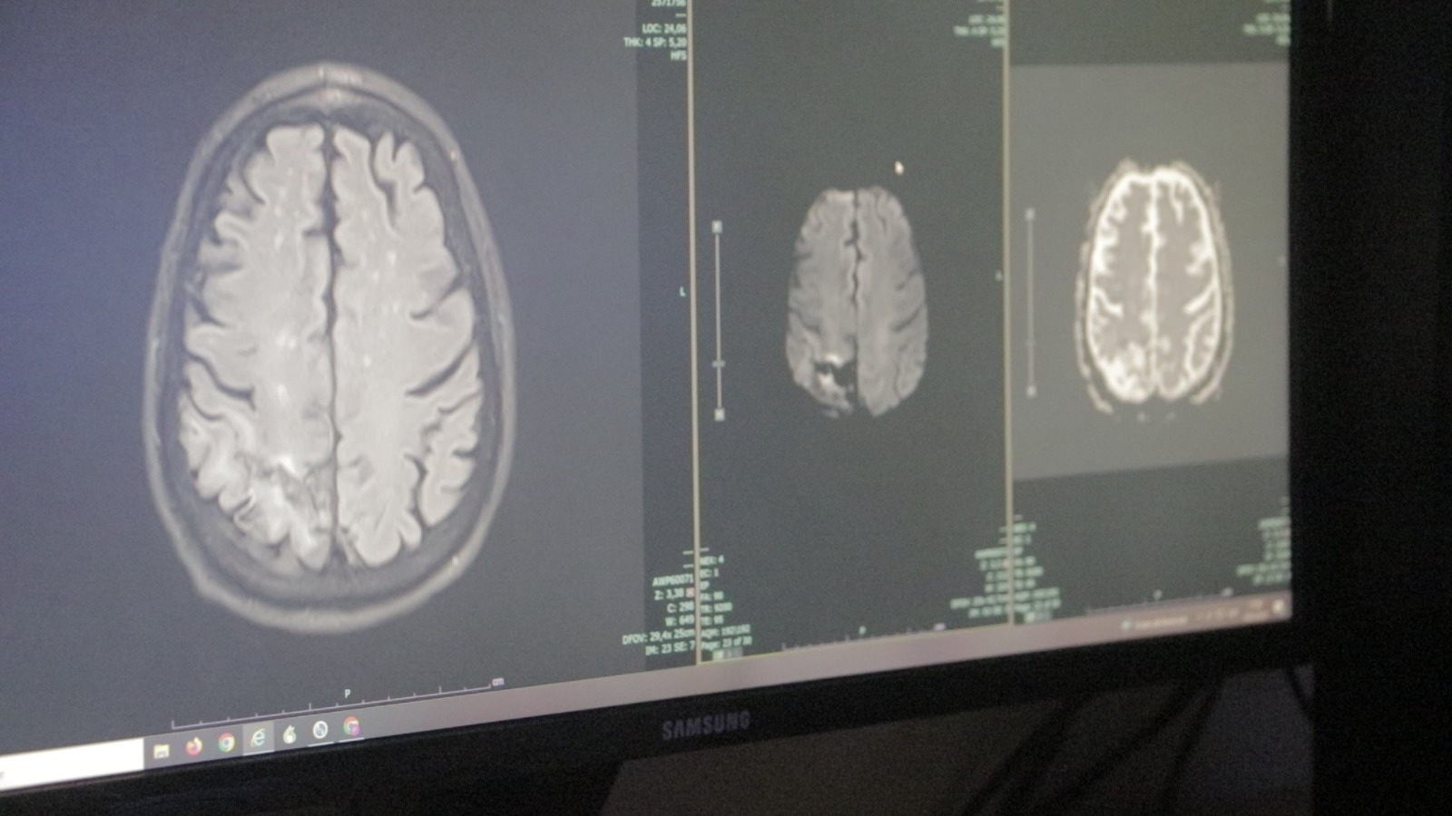 El Hospital Madariaga advierte sobre los principales factores de riesgo del ACV y la importancia de la detección temprana 7 El Hospital Madariaga advierte sobre los principales factores de riesgo del ACV y la importancia de la detección temprana imagen-6