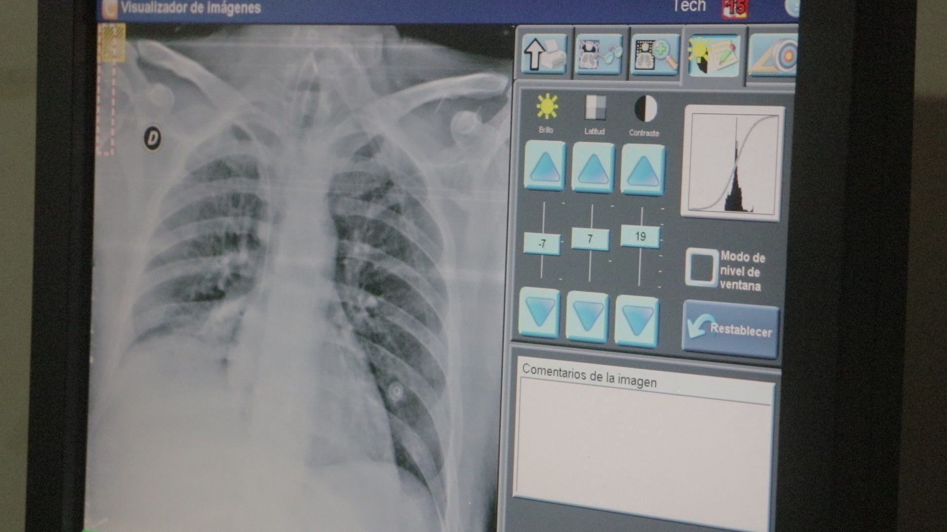 El Hospital Madariaga impulsa jornada de rehabilitación pulmonar multidisciplinaria imagen-2