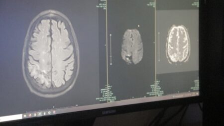 Desde el Madariaga destacan las señales de alerta del ACV para detectarlo a tiempo imagen-3