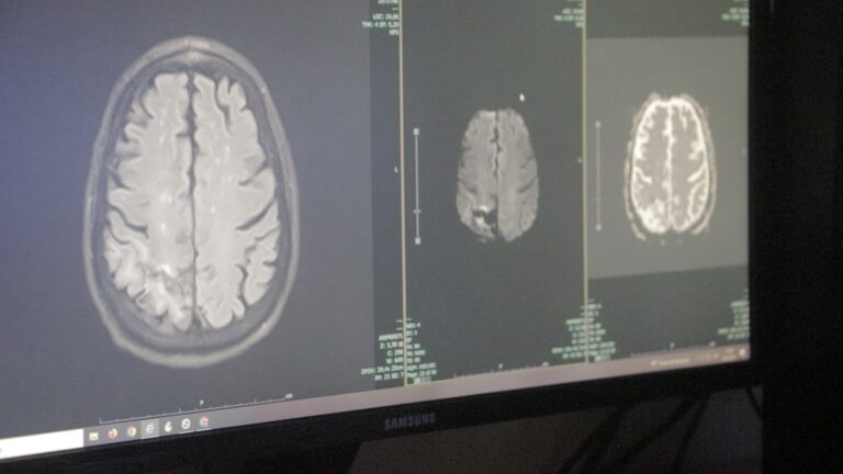Desde el Madariaga destacan las señales de alerta del ACV para detectarlo a tiempo imagen-5