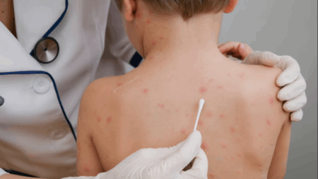 Cuáles son los síntomas del sarampión, la enfermedad que resurge por falta de vacunación Cuáles son los síntomas del sarampión, la enfermedad que resurge por falta de vacunación imagen-9