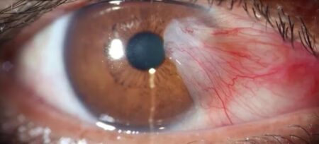 Este viernes, Campaña de Prevención de la Ceguera por Diabetes en Posadas Este viernes, Campaña de Prevención de la Ceguera por Diabetes en Posadas imagen-4