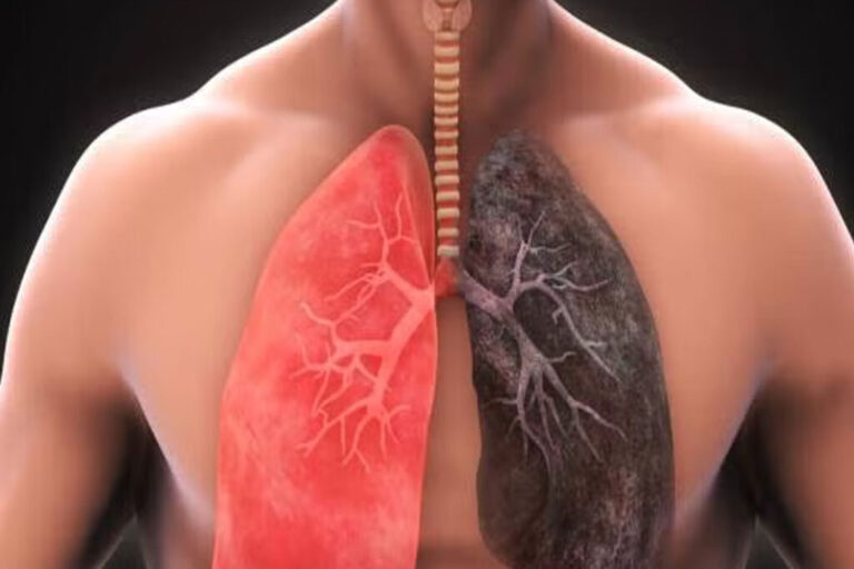 El Madariaga impulsa charla sobre EPOC: La enfermedad pulmonar que afecta mayormente a fumadores imagen-36