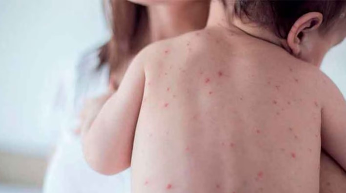 Detectan un caso de sarampión en Entre Ríos y reactivan la alerta a nivel nacional imagen-8